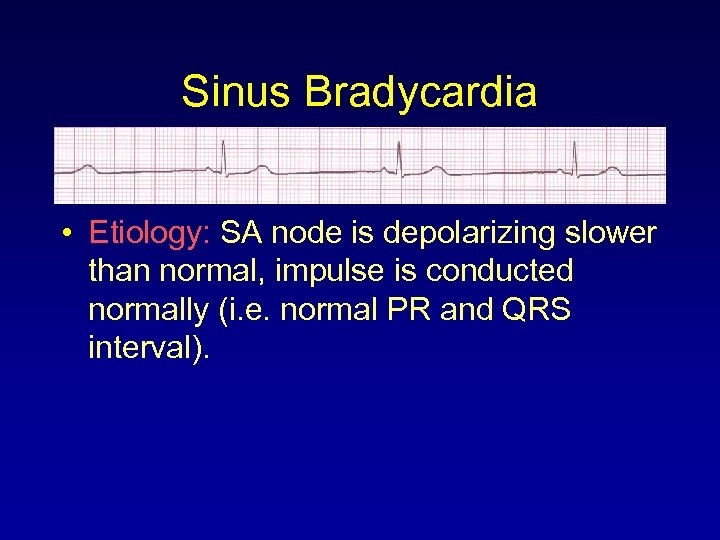 Sinus Bradycardia • Etiology: SA node is depolarizing slower than normal, impulse is conducted