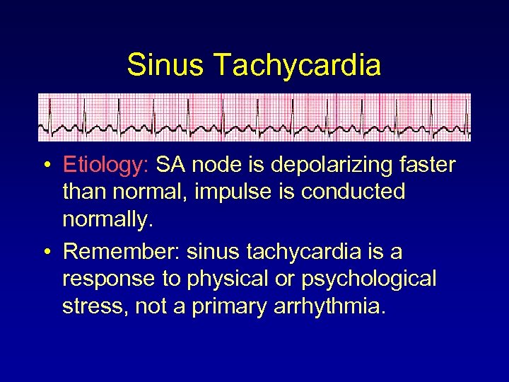 Sinus Tachycardia • Etiology: SA node is depolarizing faster than normal, impulse is conducted