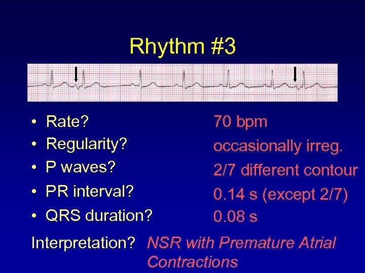 Rhythm #3 • • • Rate? Regularity? P waves? PR interval? QRS duration? 70