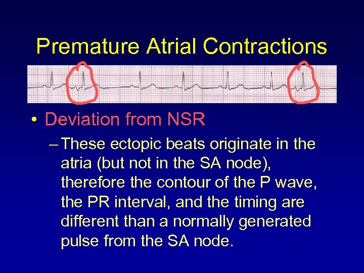 Premature Atrial Contractions • Deviation from NSR – These ectopic beats originate in the