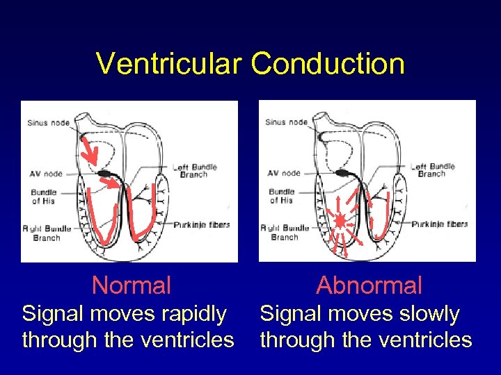 Ventricular Conduction Normal Abnormal Signal moves rapidly through the ventricles Signal moves slowly through