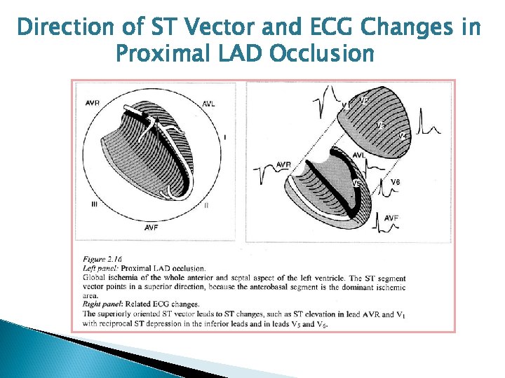 Direction of ST Vector and ECG Changes in Proximal LAD Occlusion 