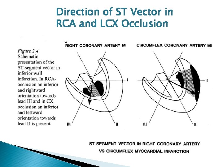 Direction of ST Vector in RCA and LCX Occlusion 