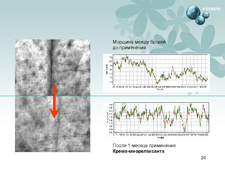 Морщина между бровей до применения После 1 месяца применения Крема-миорелаксанта 24 