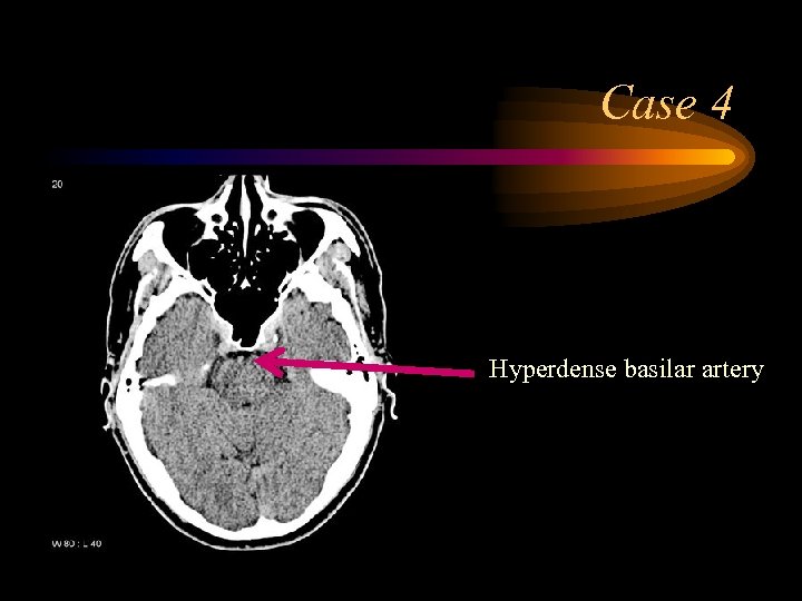Case 4 Hyperdense basilar artery 