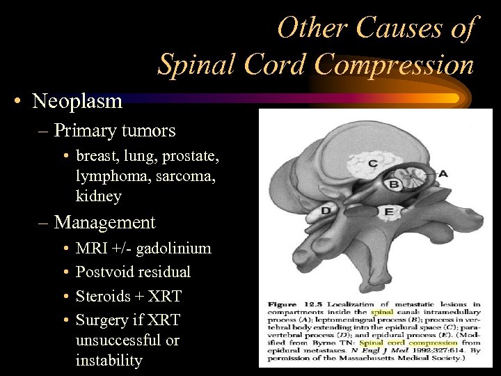 Other Causes of Spinal Cord Compression • Neoplasm – Primary tumors • breast, lung,