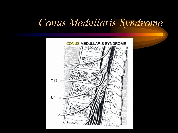 Conus Medullaris Syndrome 