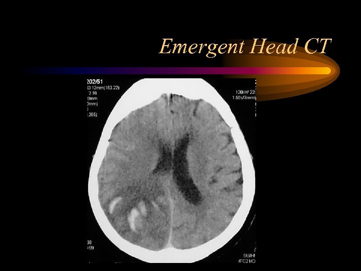 Emergent Head CT 