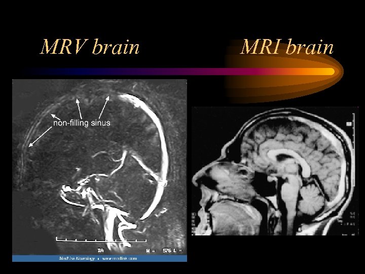 MRV brain MRI brain 