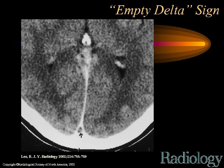 “Empty Delta” Sign Lee, E. J. Y. Radiology 2002; 224: 788 -789 Copyright ©Radiological