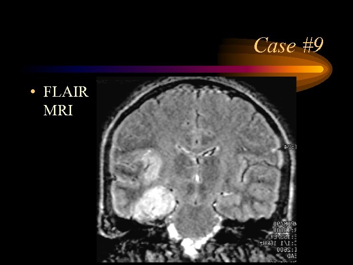 Case #9 • FLAIR MRI 