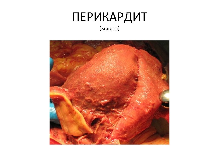 ПЕРИКАРДИТ (макро) 