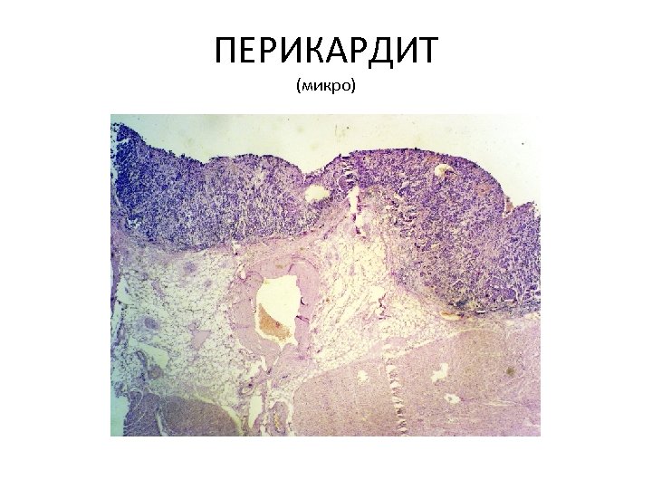 ПЕРИКАРДИТ (микро) 