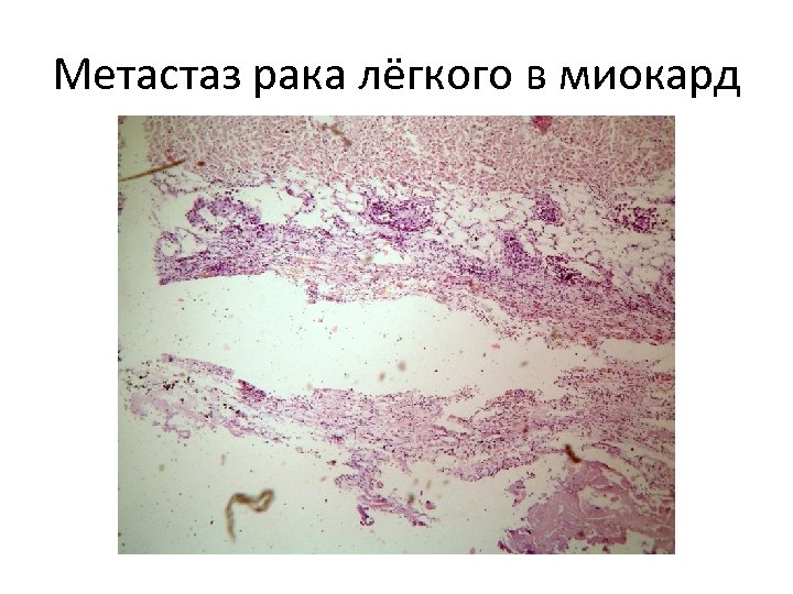 Метастаз рака лёгкого в миокард 