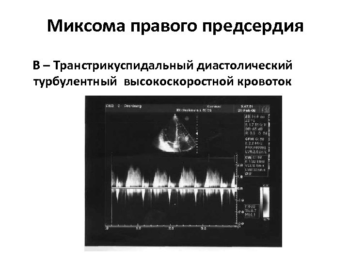 Миксома правого предсердия В – Транстрикуспидальный диастолический турбулентный высокоскоростной кровоток 