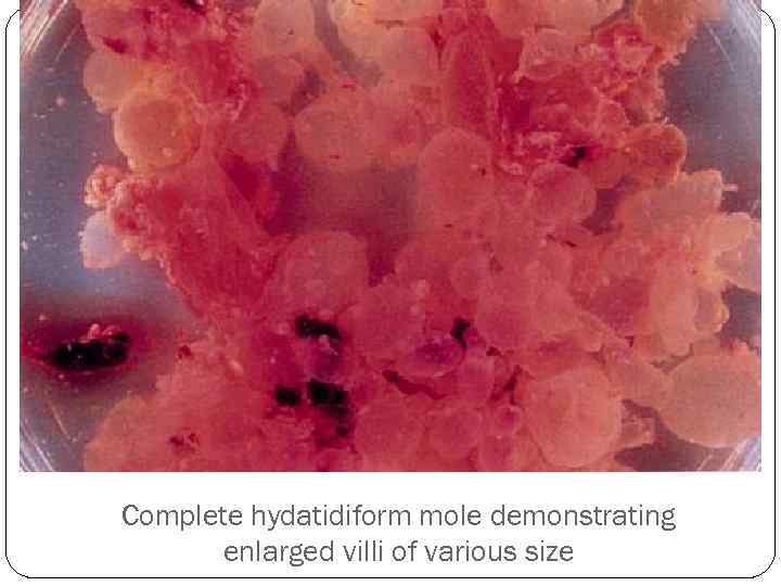 Complete hydatidiform mole demonstrating enlarged villi of various size 