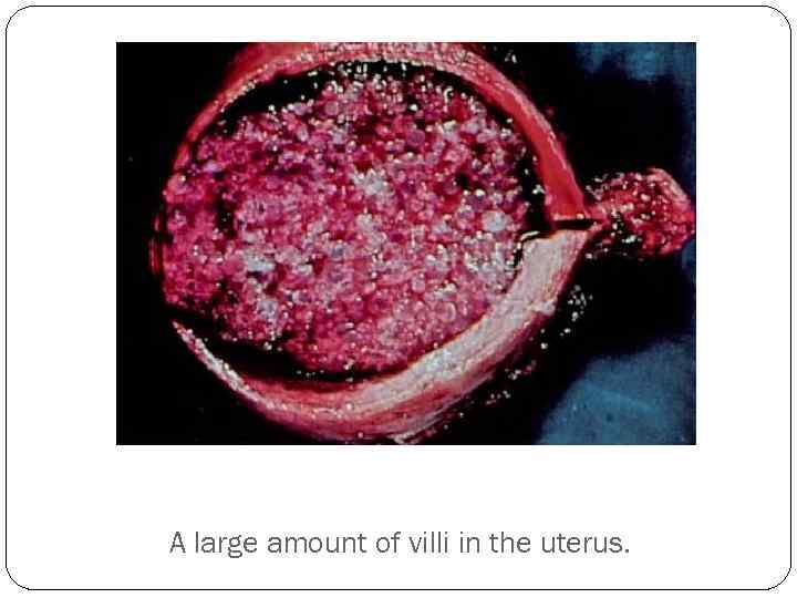 A large amount of villi in the uterus. 