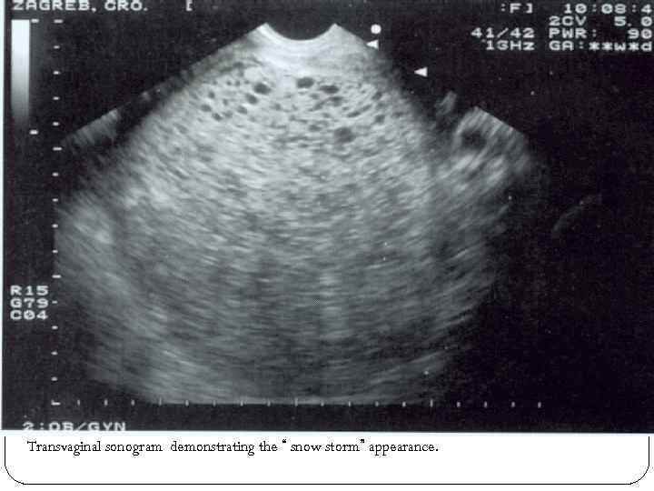 Transvaginal sonogram demonstrating the “ snow storm” appearance. 