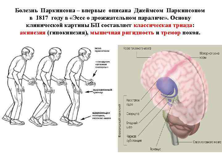 Болезнь Паркинсона – впервые описана Джеймсом Паркинсоном в 1817 году в «Эссе о дрожжательном