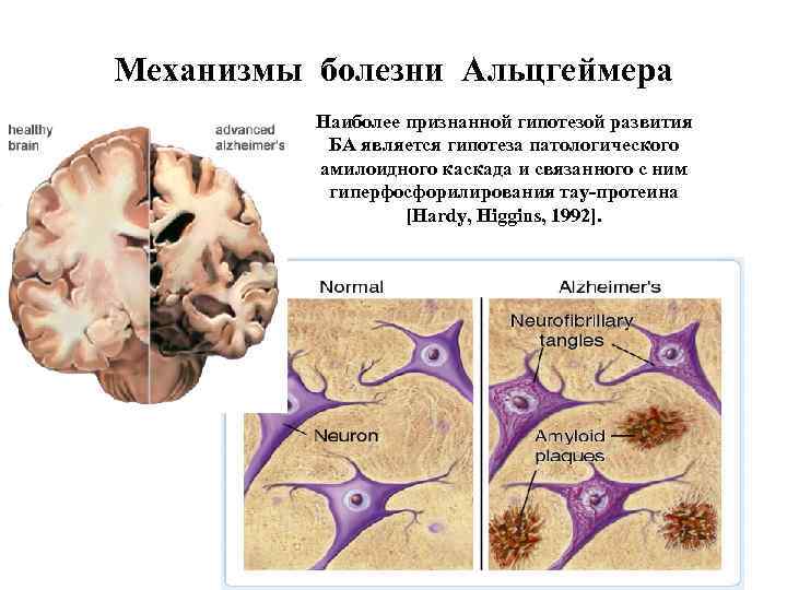 Механизмы болезни Альцгеймера Наиболее признанной гипотезой развития БА является гипотеза патологического амилоидного каскада и