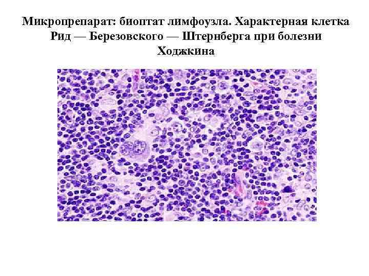 Микропрепарат: биоптат лимфоузла. Характерная клетка Рид — Березовского — Штернберга при болезни Ходжкина 