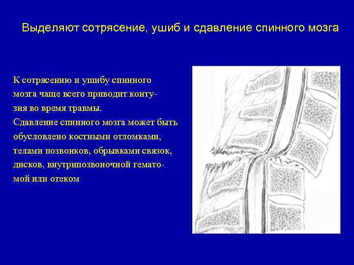 Выделяют сотрясение, ушиб и сдавление спинного мозга К сотрясению и ушибу спинного мозга чаще