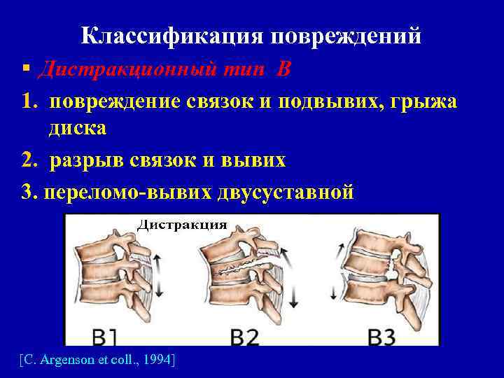 Классификация повреждений § Дистракционный тип В 1. повреждение связок и подвывих, грыжа диска 2.