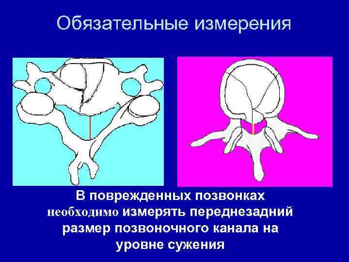 Обязательные измерения В поврежденных позвонках необходимо измерять переднезадний размер позвоночного канала на уровне сужения