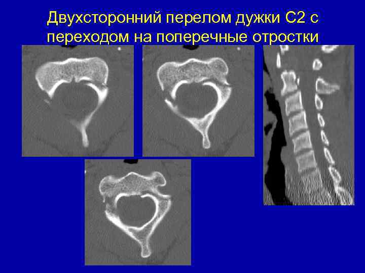 Двухсторонний перелом дужки С 2 с переходом на поперечные отростки 