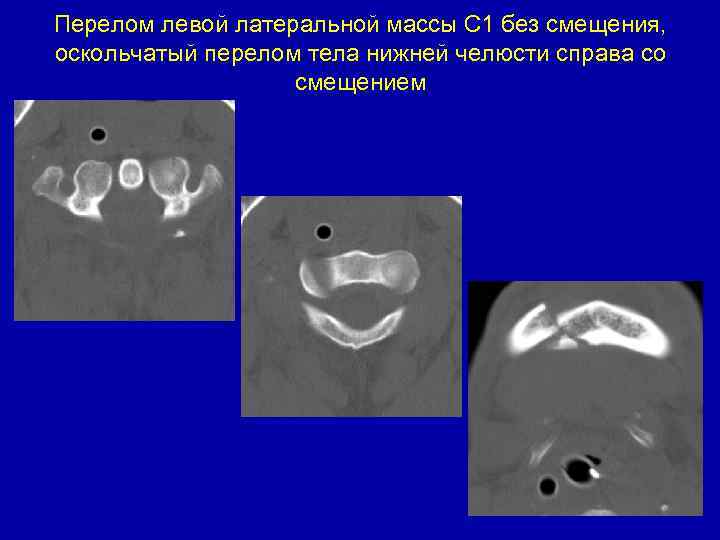 Перелом левой латеральной массы С 1 без смещения, оскольчатый перелом тела нижней челюсти справа