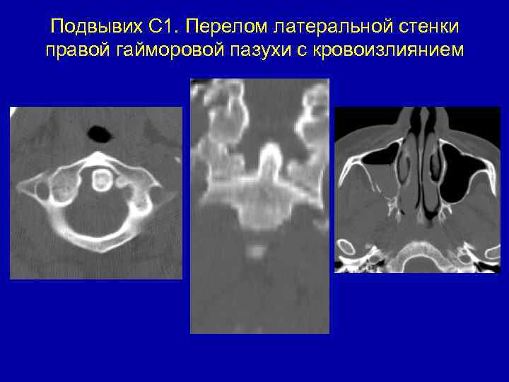 Подвывих С 1. Перелом латеральной стенки правой гайморовой пазухи с кровоизлиянием 