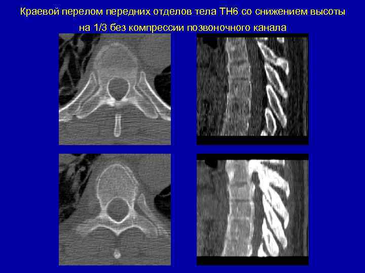 Краевой перелом передних отделов тела ТН 6 со снижением высоты на 1/3 без компрессии