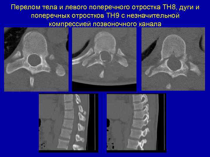 Перелом тела и левого поперечного отростка ТН 8, дуги и поперечных отростков ТН 9