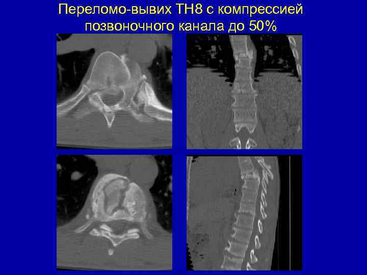 Переломо-вывих ТН 8 с компрессией позвоночного канала до 50% 