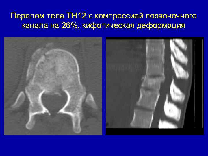 Перелом тела ТН 12 с компрессией позвоночного канала на 26%, кифотическая деформация 