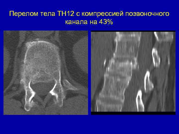 Перелом тела ТН 12 с компрессией позвоночного канала на 43% 