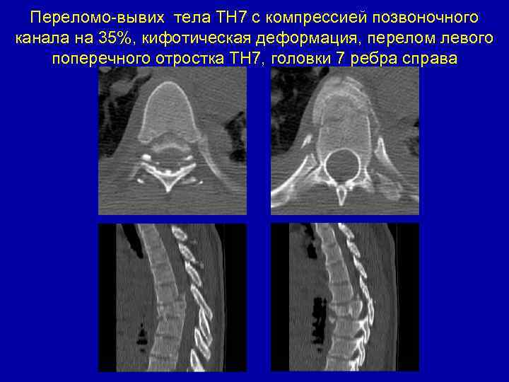 Переломо-вывих тела ТН 7 с компрессией позвоночного канала на 35%, кифотическая деформация, перелом левого