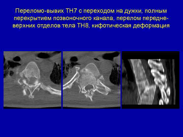 Переломо-вывих ТН 7 с переходом на дужки, полным перекрытием позвоночного канала, перелом передневерхних отделов