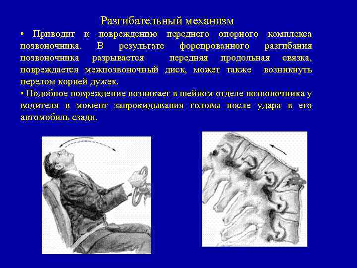 Разгибательный механизм • Приводит к повреждению переднего опорного комплекса позвоночника. В результате форсированного разгибания