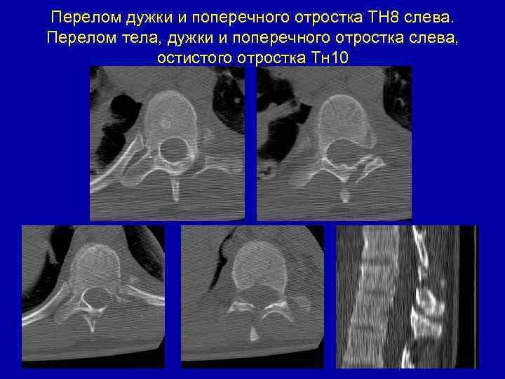 Перелом дужки и поперечного отростка ТН 8 слева. Перелом тела, дужки и поперечного отростка