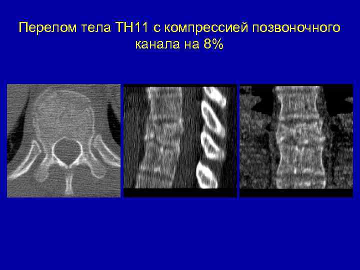 Перелом тела ТН 11 с компрессией позвоночного канала на 8% 