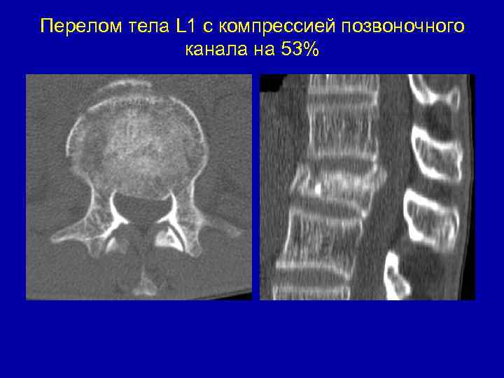 Перелом тела L 1 c компрессией позвоночного канала на 53% 