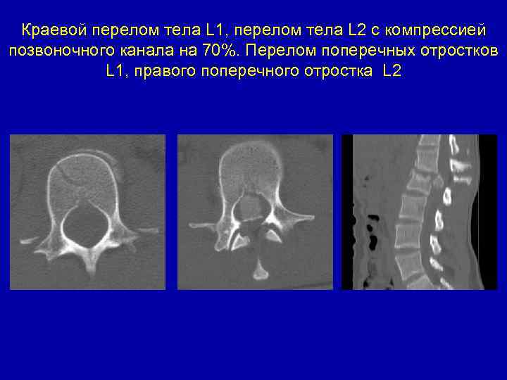 Краевой перелом тела L 1, перелом тела L 2 с компрессией позвоночного канала на