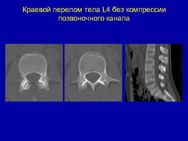 Краевой перелом тела L 4 без компрессии позвоночного канала 