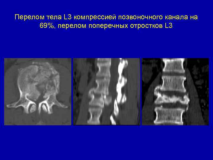 Перелом тела L 3 компрессией позвоночного канала на 69%, перелом поперечных отростков L 3