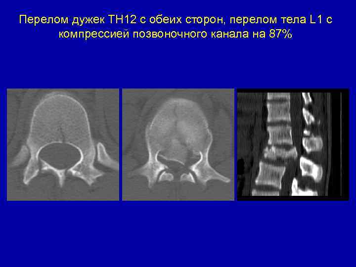 Перелом дужек ТН 12 с обеих сторон, перелом тела L 1 c компрессией позвоночного