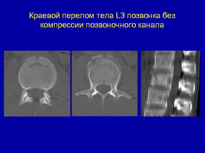 Краевой перелом тела L 3 позвонка без компрессии позвоночного канала 