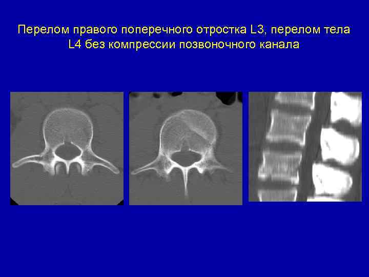 Перелом правого поперечного отростка L 3, перелом тела L 4 без компрессии позвоночного канала