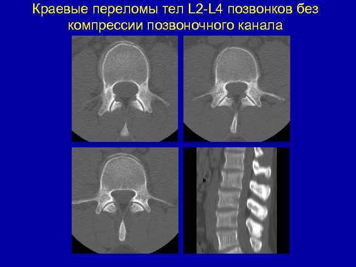 Краевые переломы тел L 2 -L 4 позвонков без компрессии позвоночного канала 