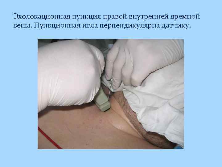 Эхолокационная пункция правой внутренней яремной вены. Пункционная игла перпендикулярна датчику. 